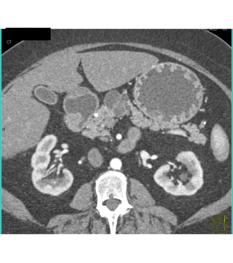 Serous Cystadenoma - CTisus CT Scan