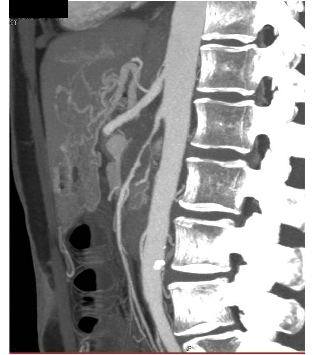 Pancreatic Cancer with Encased Superior Mesenteric Artery (SMA) Best Seen on MIP - CTisus CT Scan