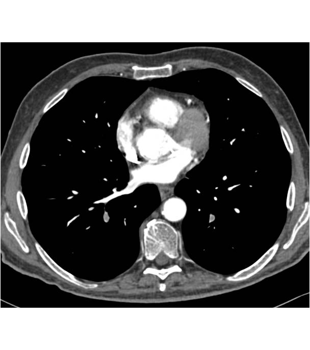 Incidental Pulmonary Embolism (PE) in a Patient with Pancreatic Cancer Metastatic to the Liver - CTisus CT Scan