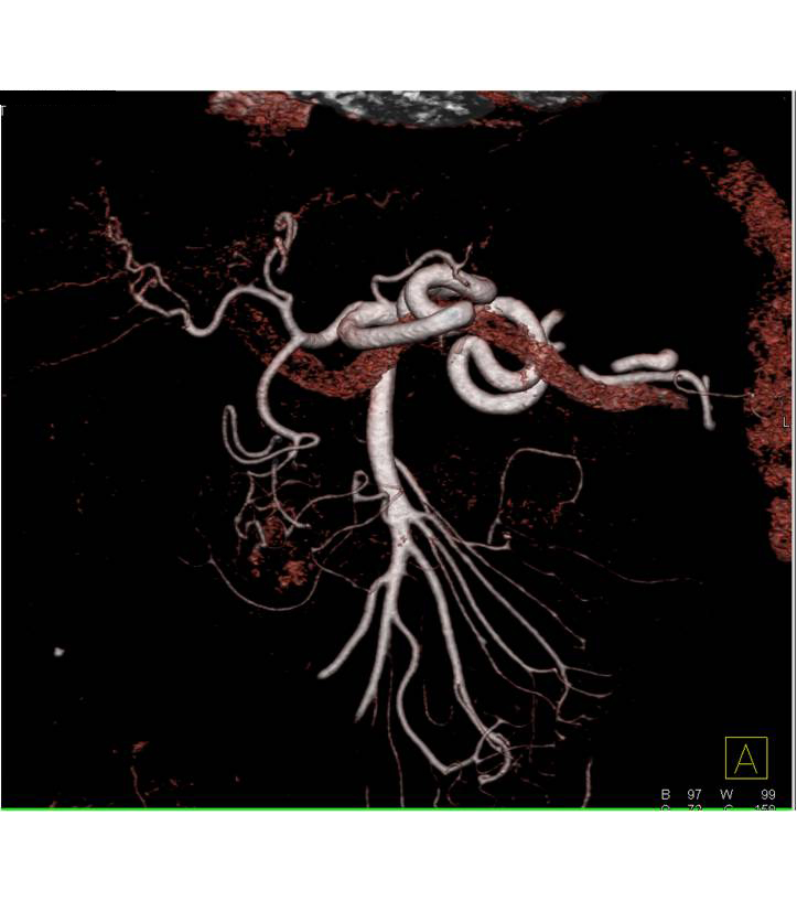 Neuroendocrine Tumor of the Pancreatic Head with CTA Mapping - CTisus CT Scan