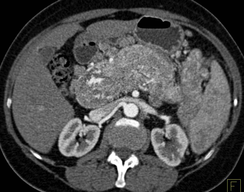 Neuroendocrine Tumor of the Pancreas with Direct Invasion of the Portal Vein and Extensive Collaterals - CTisus CT Scan