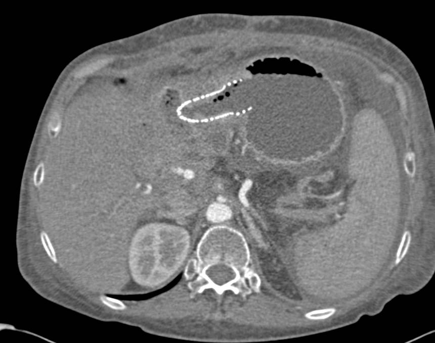 Recurrent Pancreatic Cancer with Stent Place Across Gastrojejunostomy - CTisus CT Scan