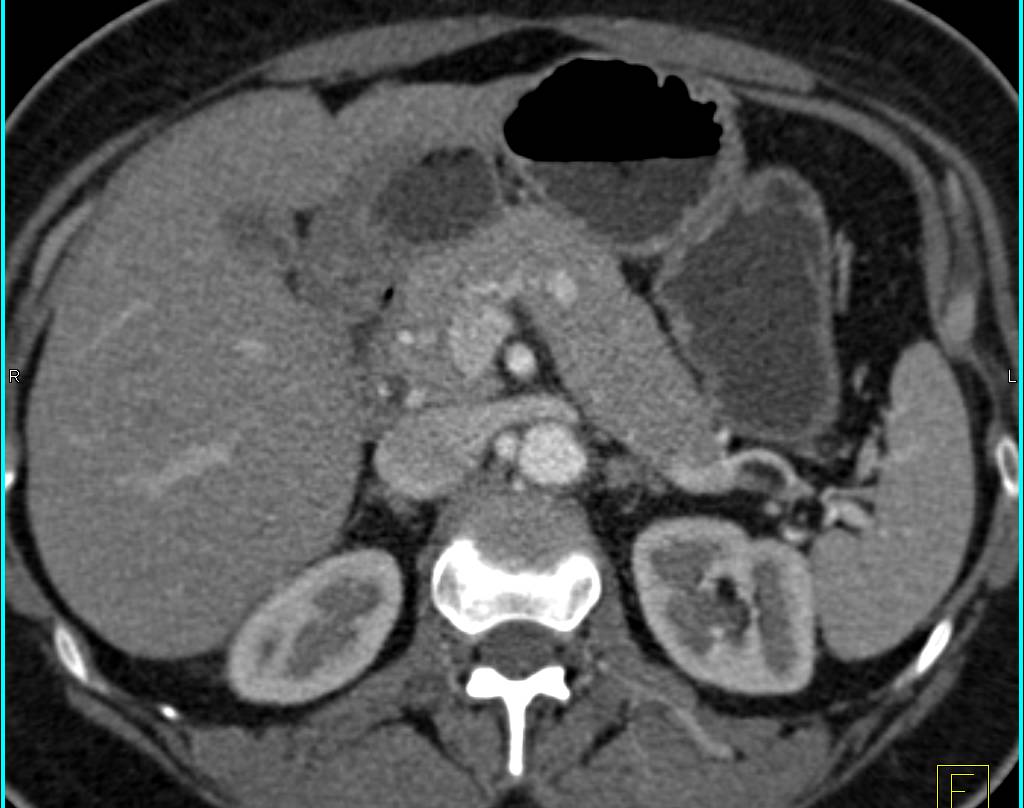 Incidental 1cm Neuroendocrine Tumor in Body of the Pancreas - CTisus CT Scan