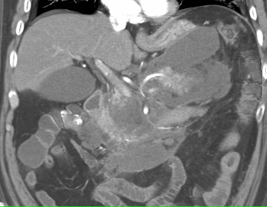 Acute Pancreatitis with Narrowing of the Superior Mesenteric Vein (SMV) - CTisus CT Scan