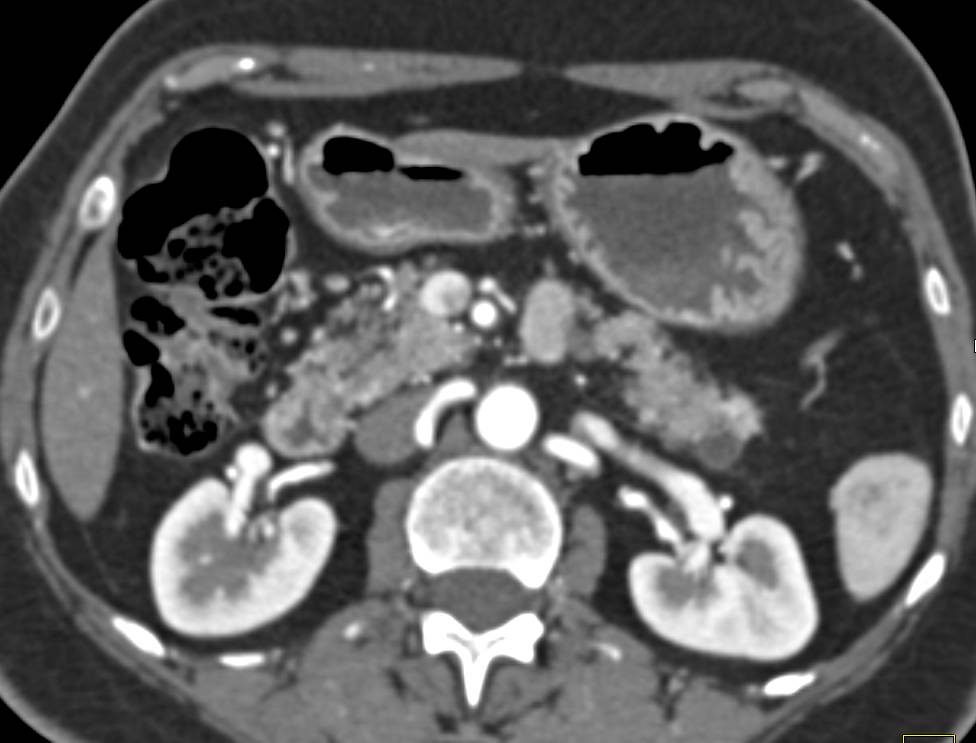 Intraductal Papillary Mucinous Neoplasm (IPMN) Tail of Pancreas - CTisus CT Scan