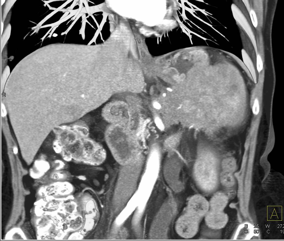 Carcinoma of the Tail of the Pancreas Invading the Spleen and the Portal Vein and Splenic Vein - CTisus CT Scan