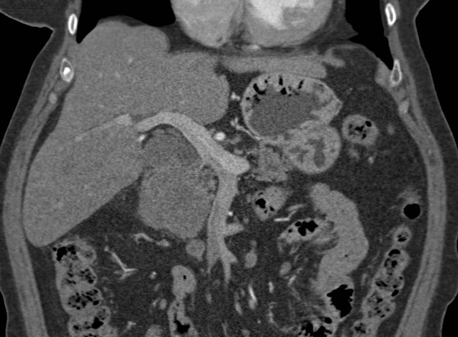 Neuroendocrine Tumor that is Hypovascular in the Head of the Pancreas - CTisus CT Scan