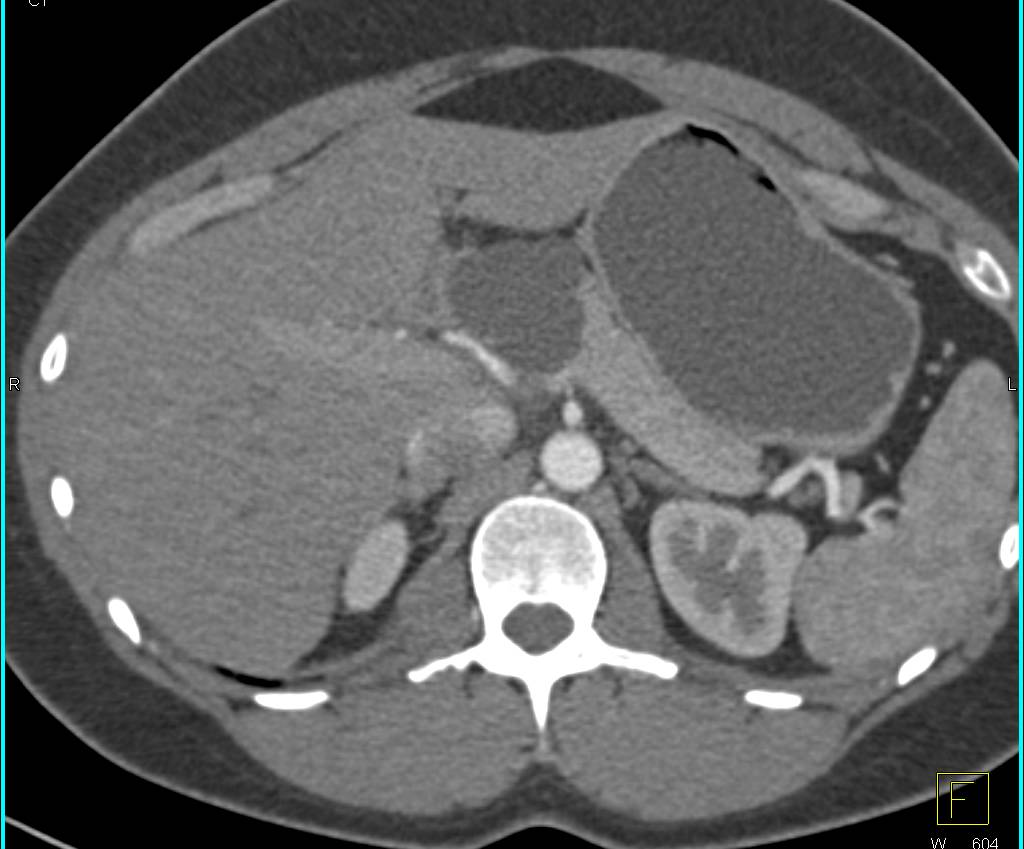 Intraductal Papillary Mucinous Neoplasm (IPMN) of the Pancreas - CTisus CT Scan