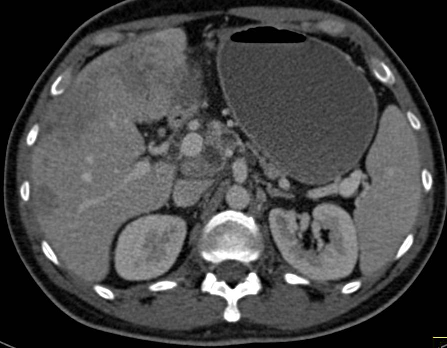 Pancreatic Cancer with Liver Metastases - CTisus CT Scan