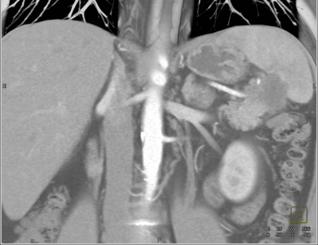 Carcinoma of the Tail of the Pancreas Invading the Spleen - CTisus CT Scan