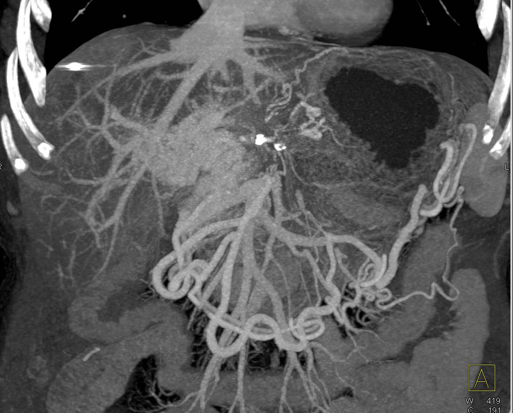 Infiltrating Pancreatic Cancer with Occlusion of the Portal vein with Cavernous Transformation of the Portal Vein - CTisus CT Scan