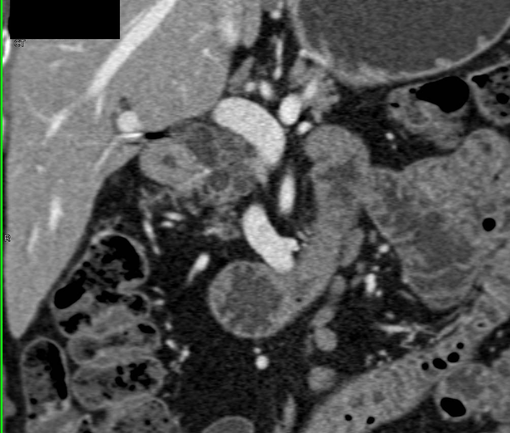 Intraductal Papillary Mucinous Neoplasm (IPMN) with Mild Dysplasia (see septations) - CTisus CT Scan