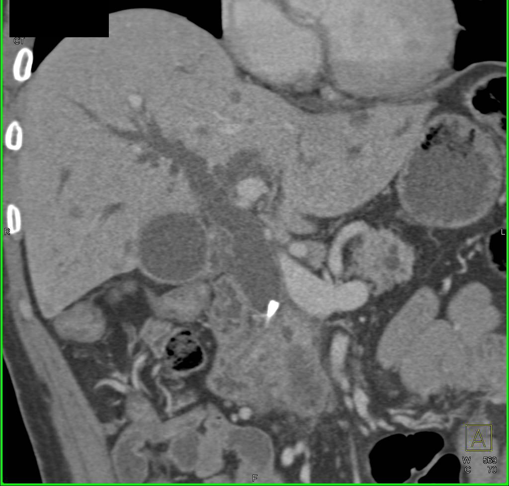 Pancreatic Cancer with Dilated Common Bile Duct (CBD) and Stent in CBD - CTisus CT Scan