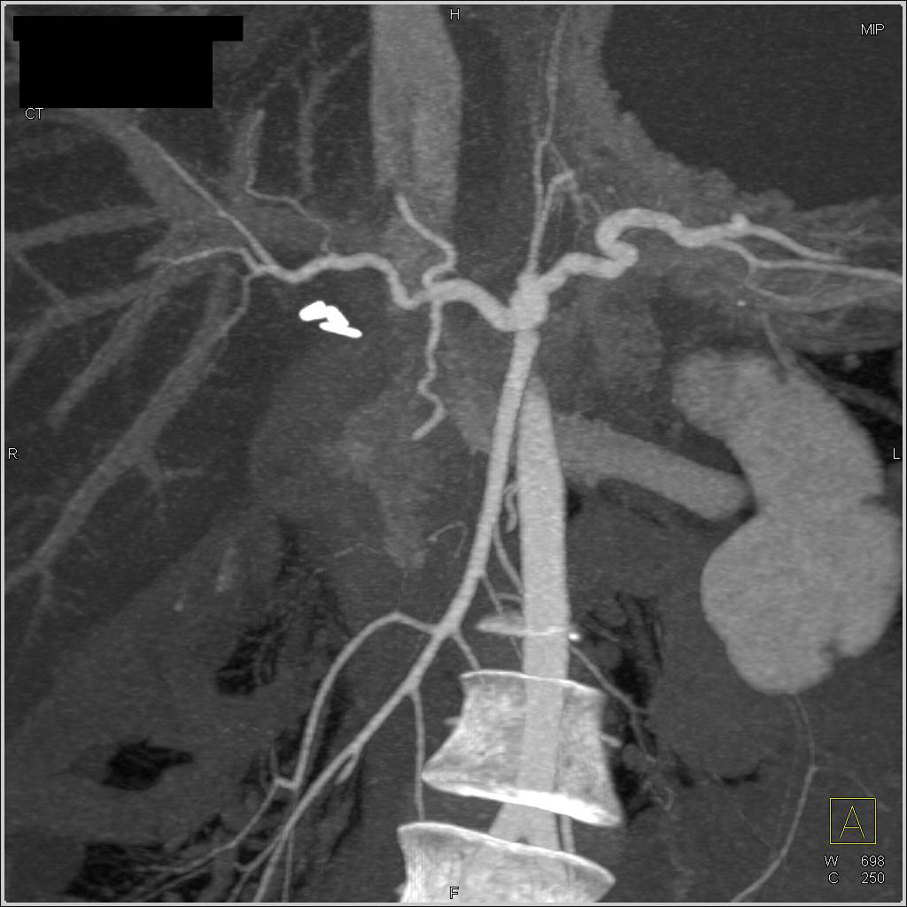 Pancreatic Cancer Encases the Portal Vein - CTisus CT Scan