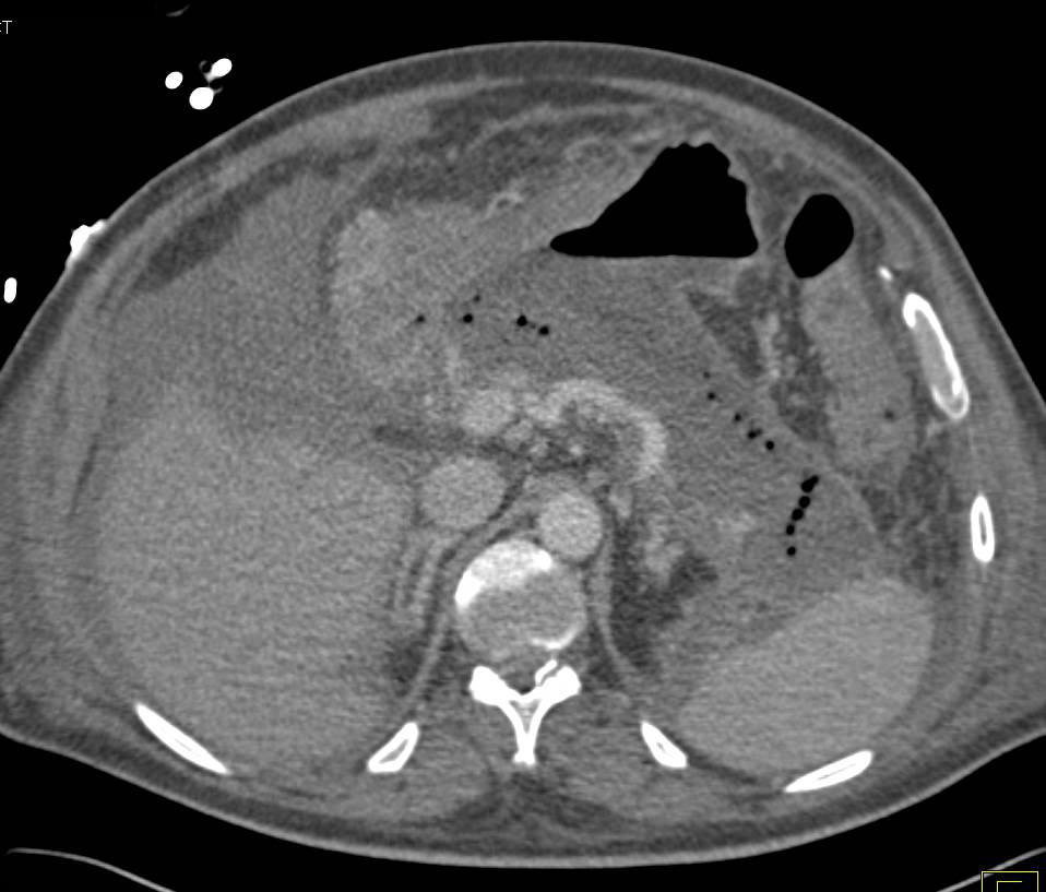 Acute Pancreatitis with Areas of Pancreatic Necrosis - CTisus CT Scan