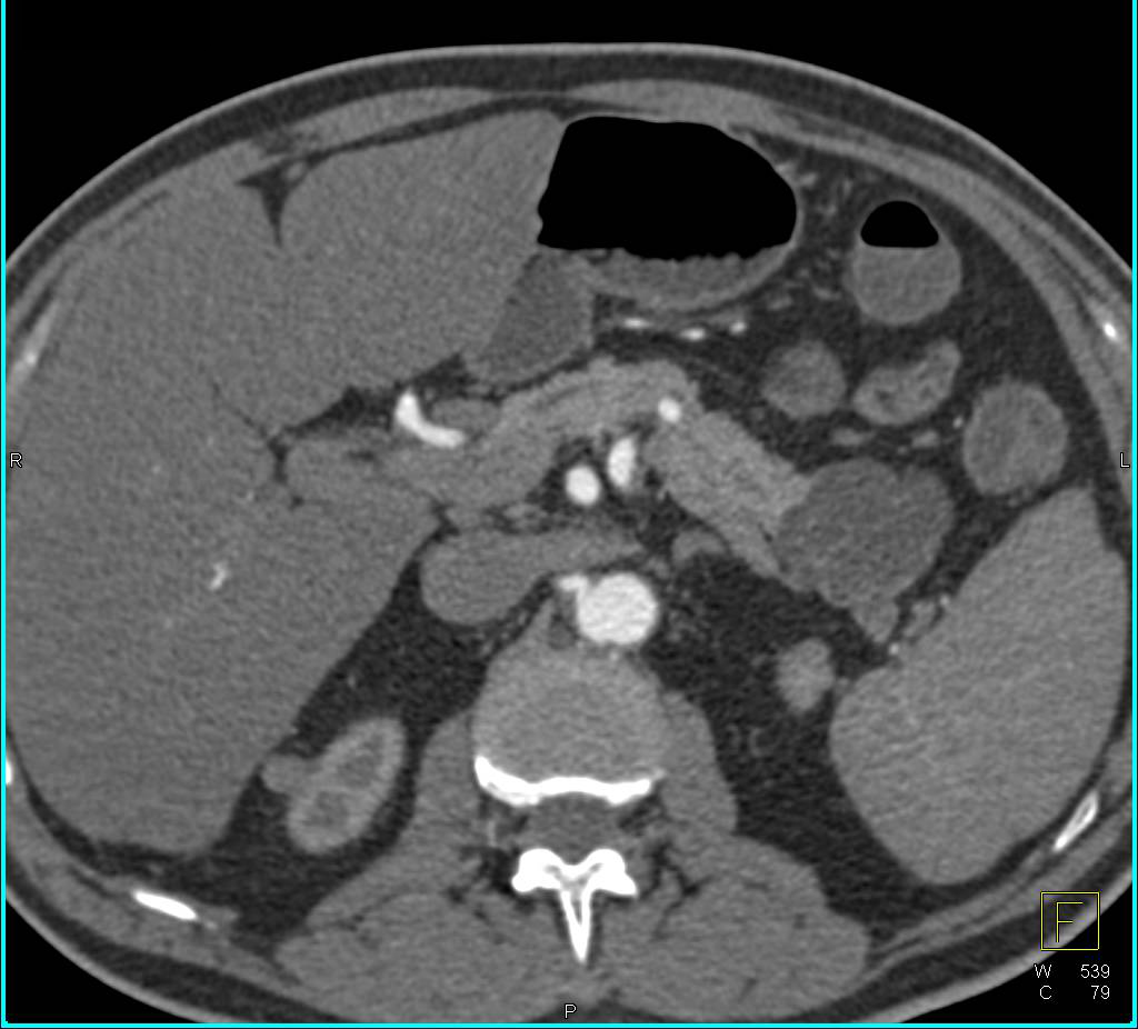 Intraductal Papillary Mucinous Neoplasm (IPMN) Tail of Pancreas - CTisus CT Scan