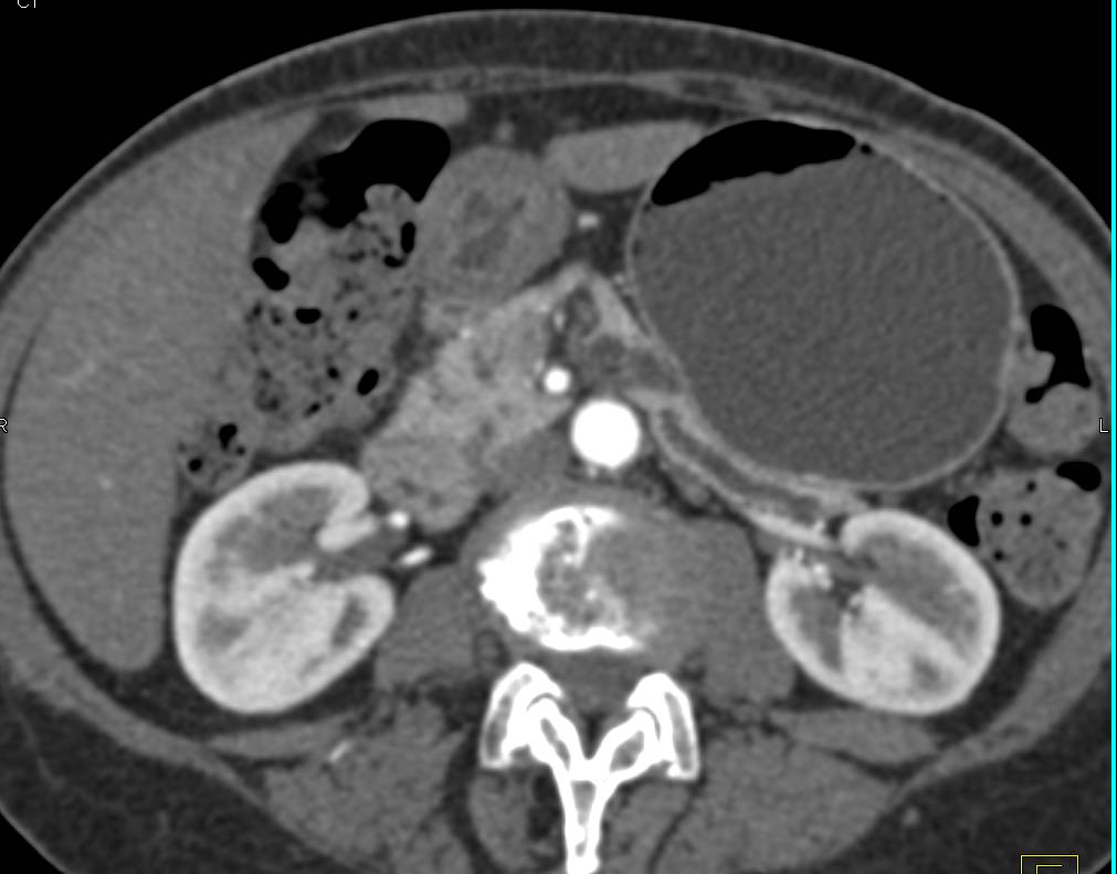 Intraductal Papillary Mucinous Neoplasm (IPMN) of the Body of the Pancreas with Dilated Duct - CTisus CT Scan