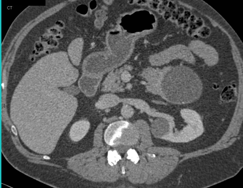 Pseudocyst vs Old hematoma in A Patient s/p Prior Distal Pancreatectomy and Splenectomy for Benign Intraductal Papillary Mucinous Neoplasm (IPMN) - CTisus CT Scan