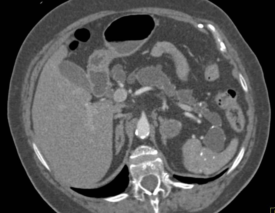 Central Intraductal Papillary Mucinous Neoplasm (IPMN) with Dilated Duct Throughout the Gland. Dysplastic Changes Seen at Pathology - CTisus CT Scan