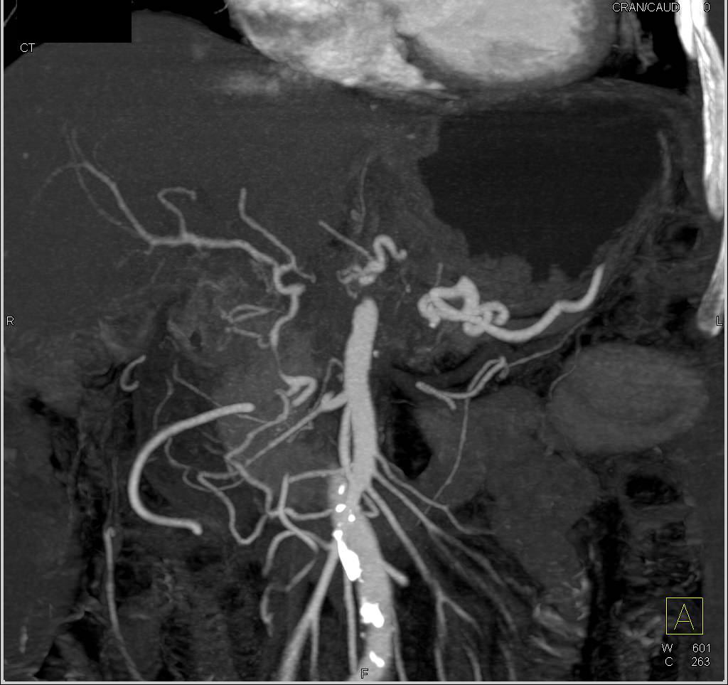 Pancreatic Cancer with Arterial Encasement - CTisus CT Scan