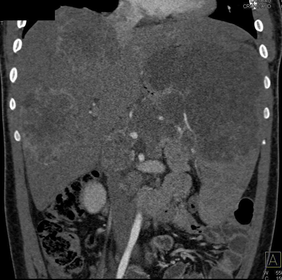 Metastatic Neuroendocrine Tumor to Liver, Spleen and Nodes - CTisus CT Scan