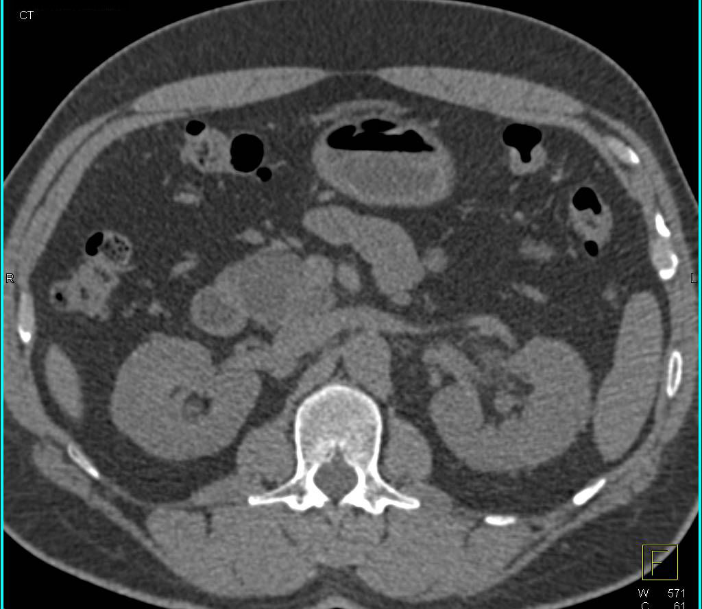 Intraductal Papillary Mucinous Neoplasm (IPMN) Head of Pancreas with Dilated Pancreatic Duct and Incidental Left Renal Cell Carcinoma - CTisus CT Scan