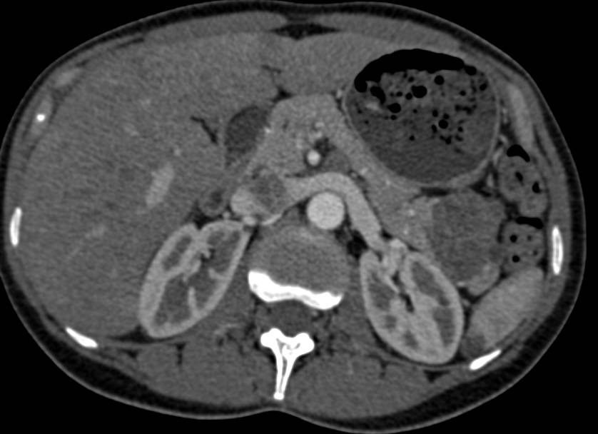 Serous Cystadenoma in Tail of Pancreas - CTisus CT Scan