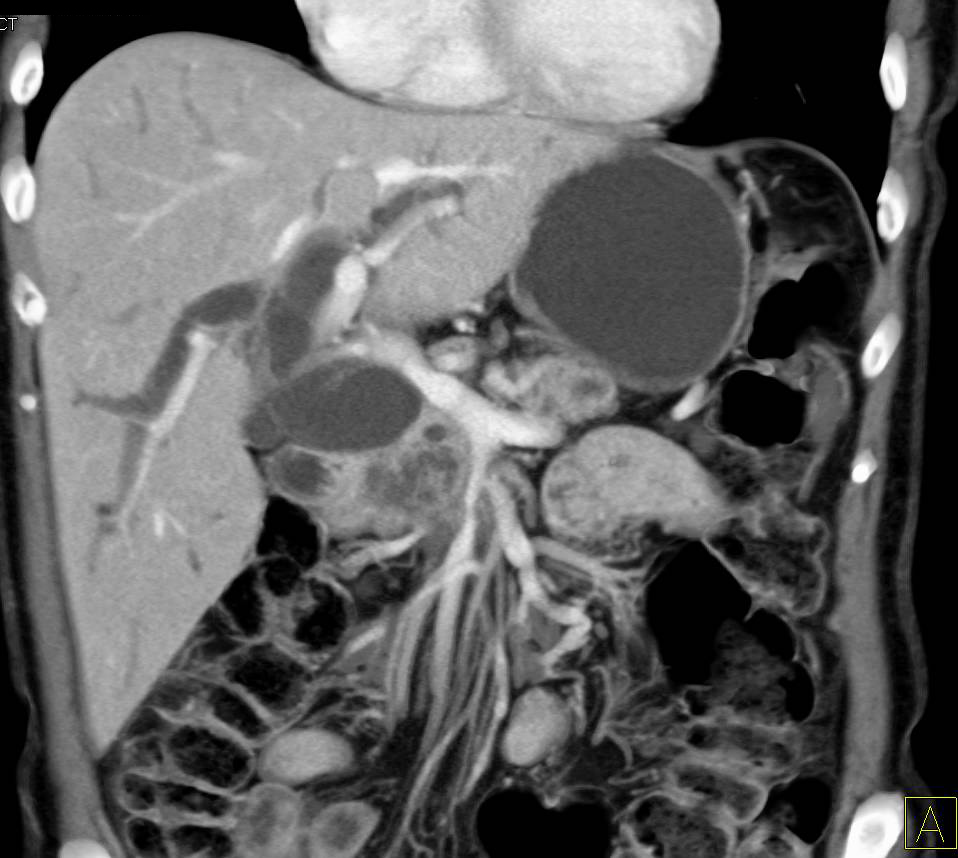 Pancreatic Cancer Obstructs the Common Bile Duct and Encases the Superior Mesenteric Vein (SMV) - CTisus CT Scan