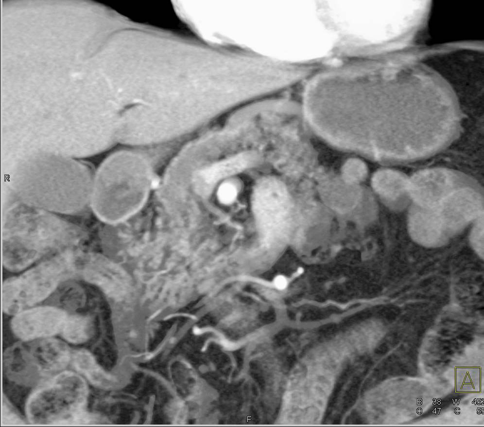 Cystic Tumor Head of Pancreas with Obstructed Pancreatic Duct. Tumor was Malignant at Pathology - CTisus CT Scan