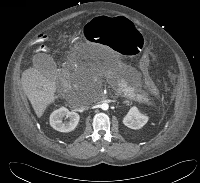 Acute Pancreatitis with Inflammation of Duodenum and Small Bowel Mesentery - CTisus CT Scan