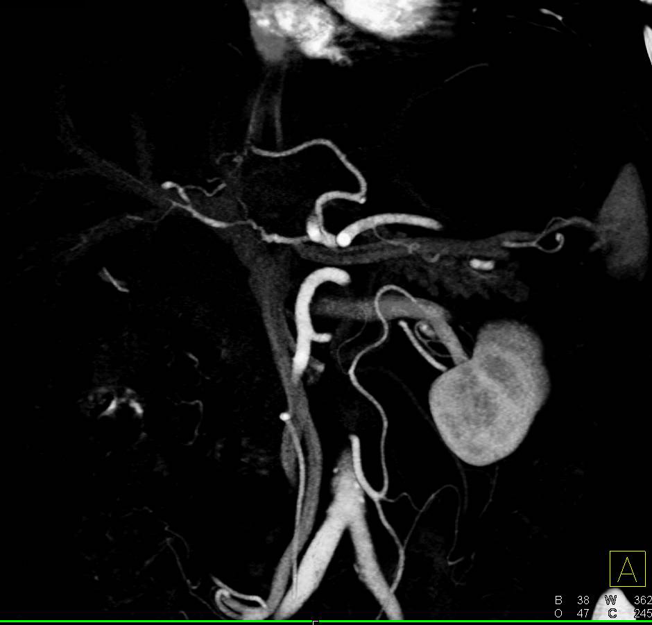 Pancreatic Cancer with Hepatic Artery Encasement and Liver Metastases - CTisus CT Scan