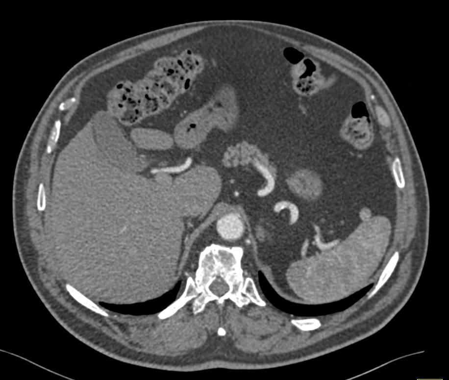 Accessory Spleen in Tail of Pancreas Simulates an Islet Cell Tumor - CTisus CT Scan