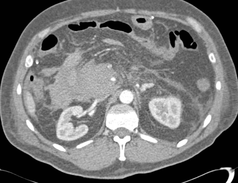 Pancreatic Cancer with Active Bleed and Hematoma s/p Biopsy - CTisus CT Scan