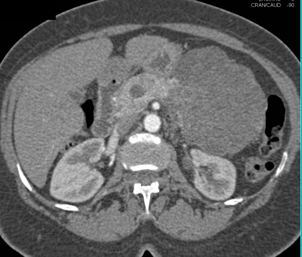 Serous Cystadenoma in Tail of Pancreas - CTisus CT Scan
