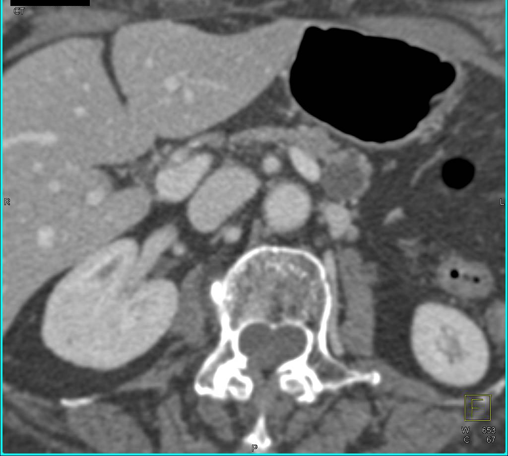 Intraductal Papillary Mucinous Neoplasms (IPMNs) - CTisus CT Scan