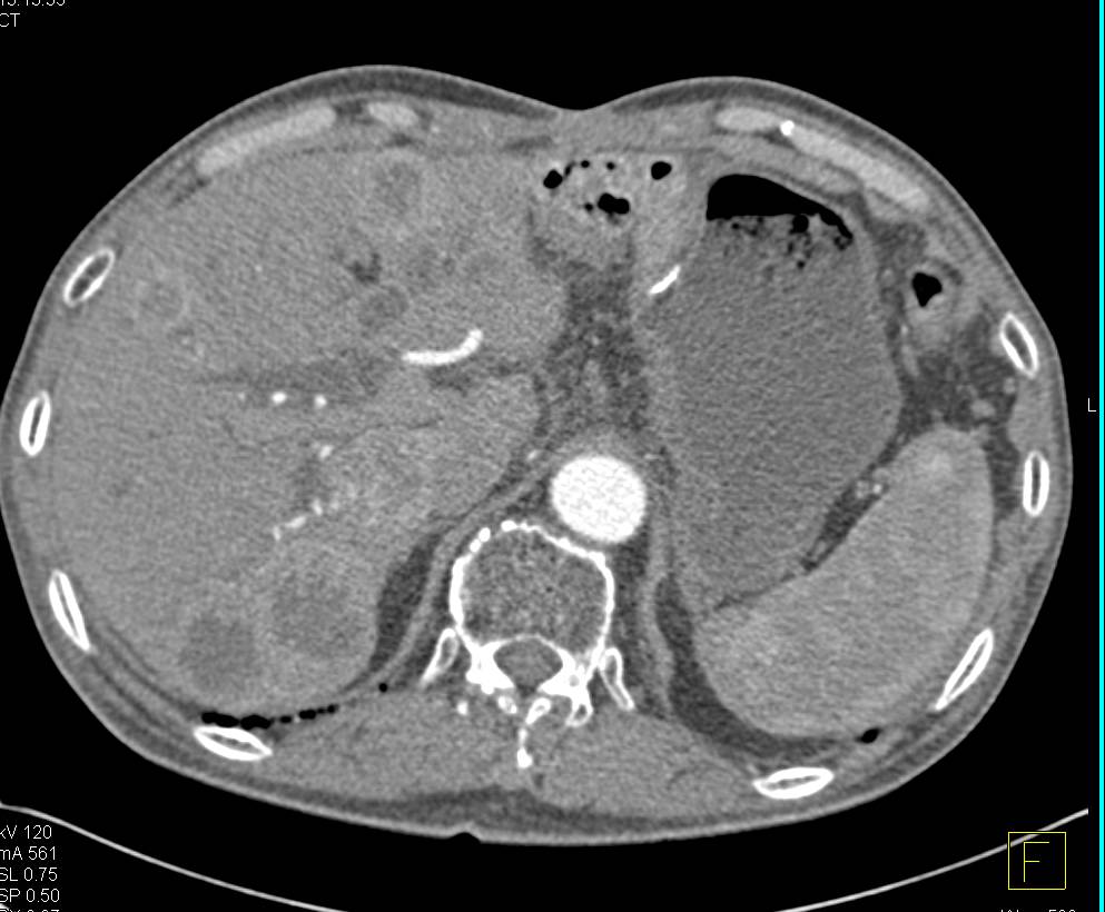 Pancreatic Cancer with Liver Metastases and Vascular Encasement - CTisus CT Scan