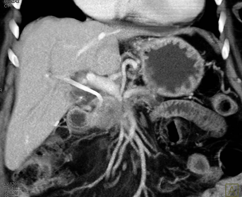 Pancreatic Cancer Encases PV/SMV Junction - CTisus CT Scan