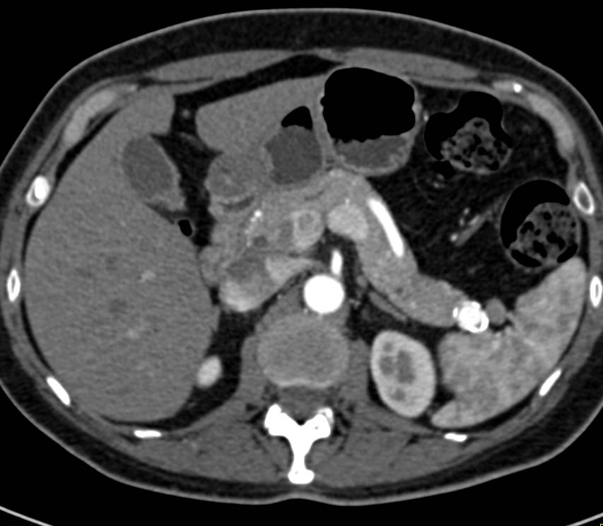 Splenic Artery Aneurysm Simulates a Neuroendocrine Tumor in the Tail of the Pancreas - CTisus CT Scan