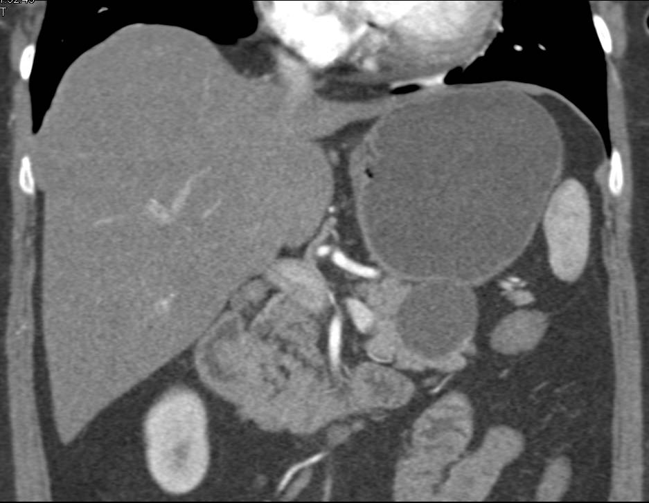 Serous Cystadenoma - CTisus CT Scan