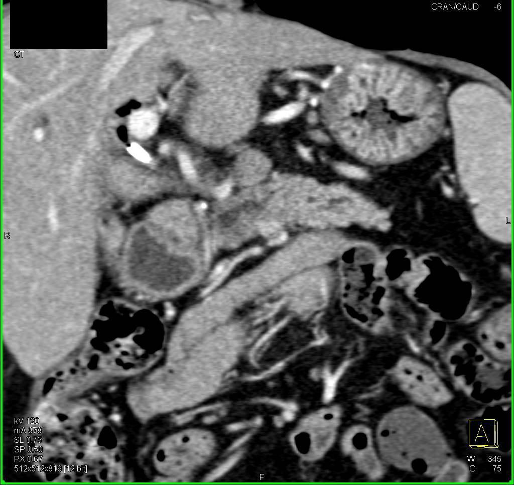 Subtle Cancer in Head of Pancreas - CTisus CT Scan