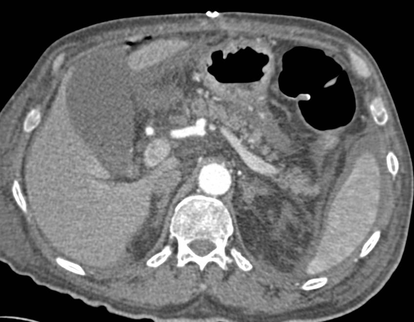 Sequelae of Panceatitis - CTisus CT Scan