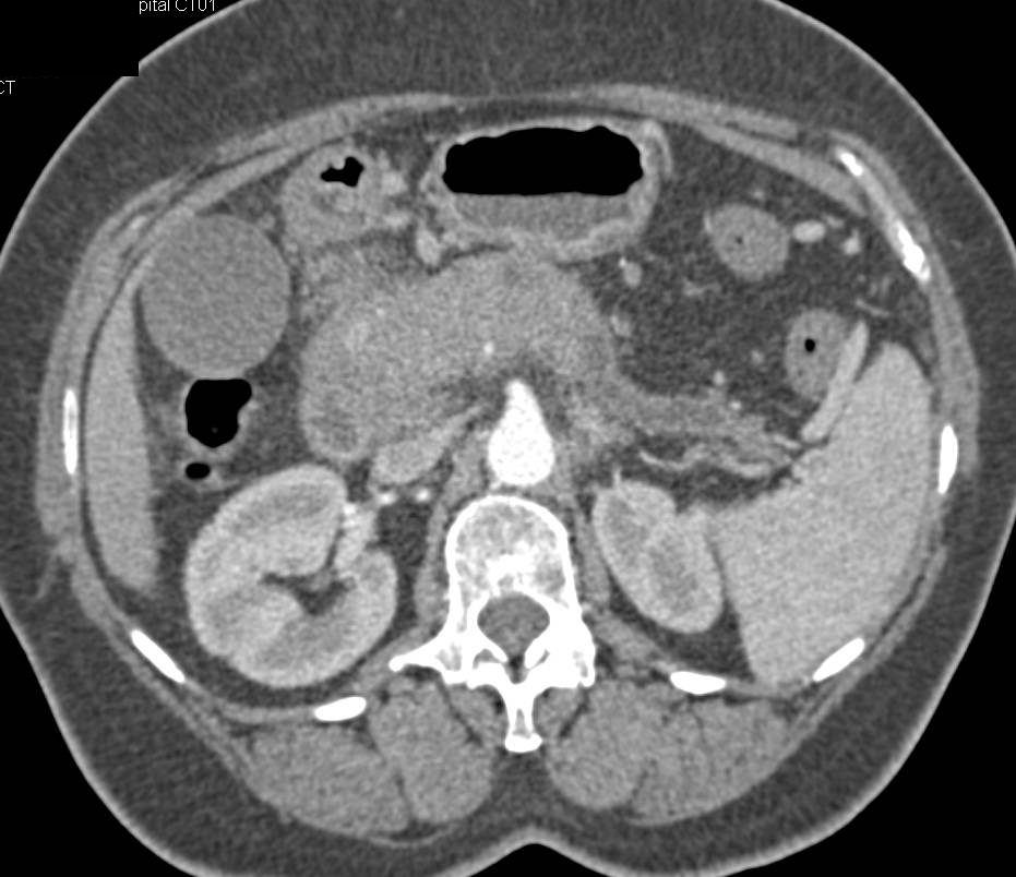 Pancreatic Adenocarcinoma Encases the PV/SMV Confluence with Extensive Collaterals - CTisus CT Scan