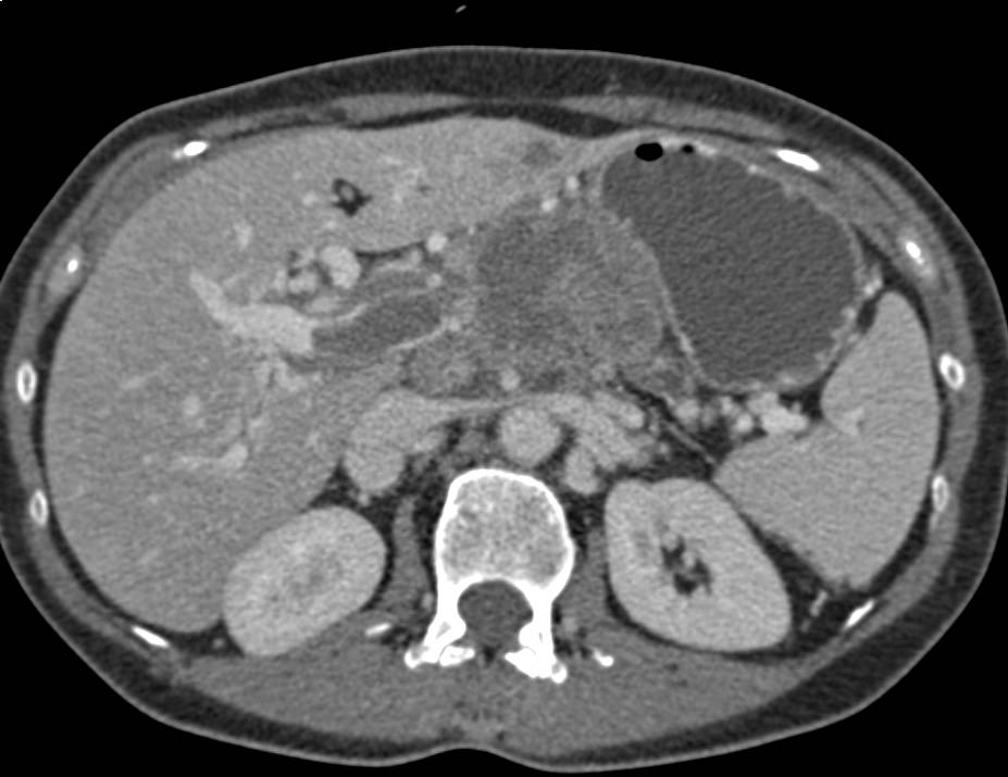 Islet Cell Tumor of the Pancreas with Portal Vein Thrombosis - CTisus CT Scan