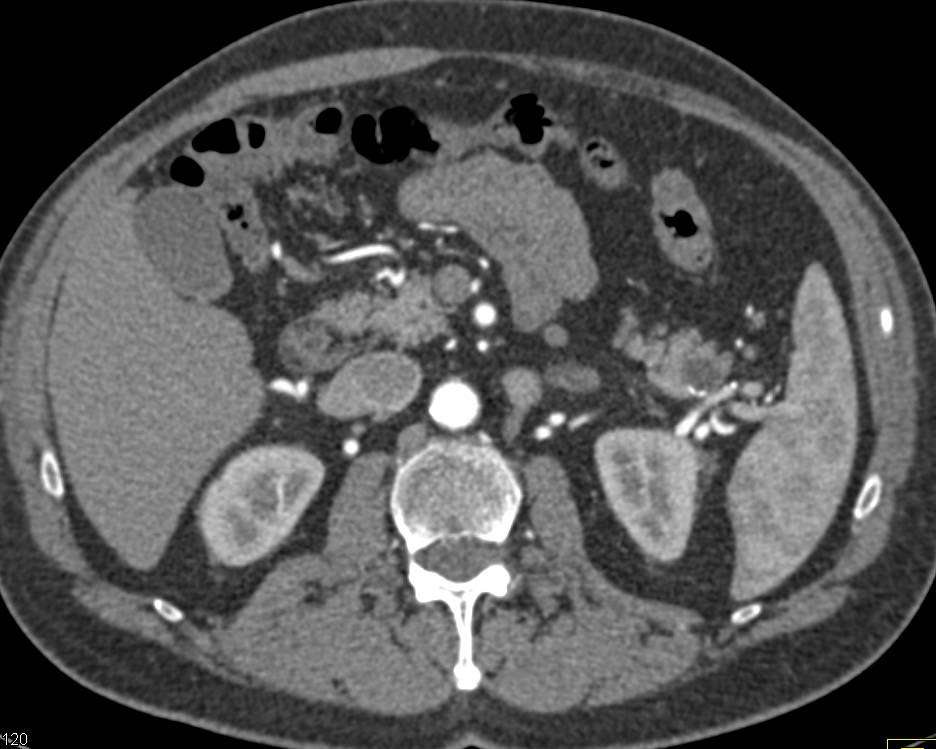 Intraductal Papillary Mucinous Neoplasm (IPMN) in Tail of the Pancreas - CTisus CT Scan