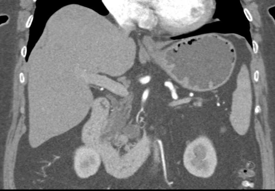 Intraductal Papillary Mucinous Neoplasm (IPMN) - CTisus CT Scan