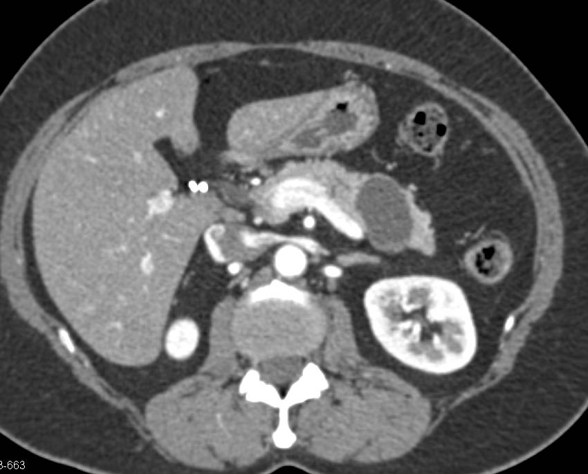 Serous Cystadenoma - CTisus CT Scan