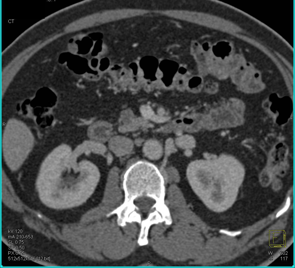 Intraductal Papillary Mucinous Neoplasm (IPMN) - CTisus CT Scan