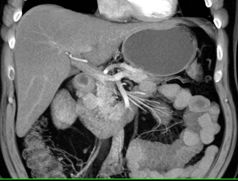 2 cm Gastrinoma Near the Head of the Pancreas which is Vascular on 3D Map - CTisus CT Scan