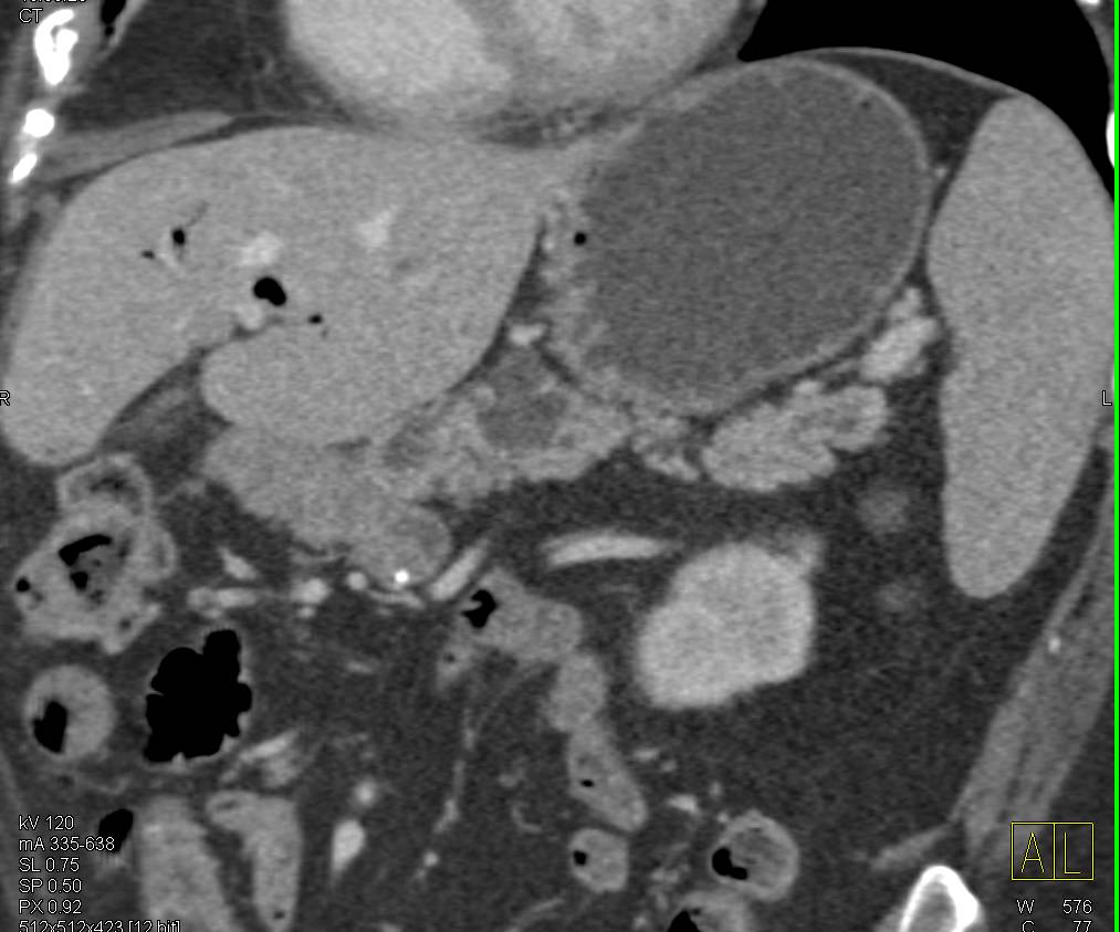 Central Intraductal Papillary Mucinous Neoplasm (IPMN) with Dilated Duct Throughout the Gland. Dysplastic Changes Seen at Pathology - CTisus CT Scan