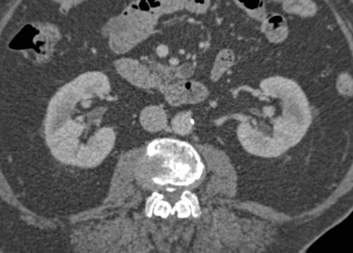 Intraductal Papillary Mucinous Neoplasm (IPMN) in Uncinate Process - CTisus CT Scan